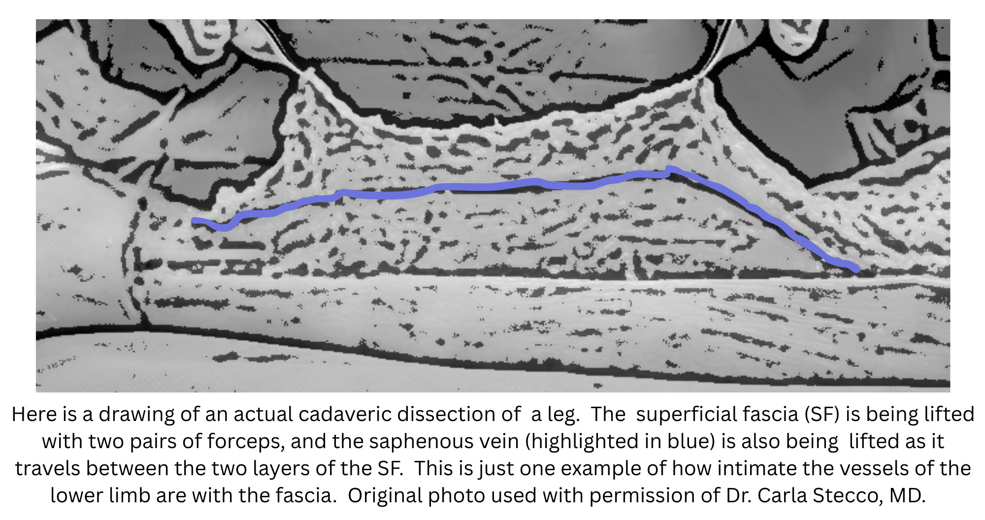 Saph Vein